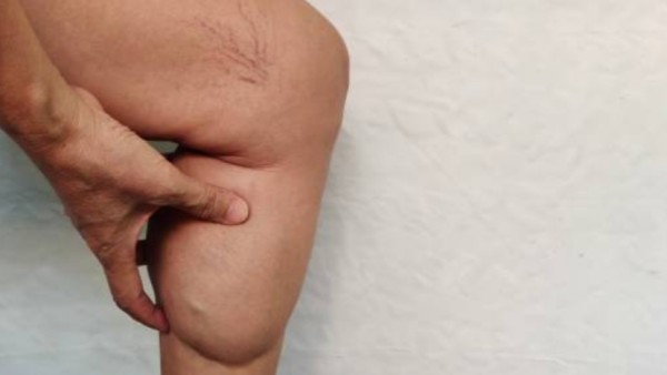 Penelitian terbaru dari Norwegian University of Science and Technology (NTNU) mengungkap bahwa diet rendah karbohidrat dapat membantu mengurangi rasa nyeri pada penderita, meski tidak secara signifikan menghilangkan lemak lipoedema.