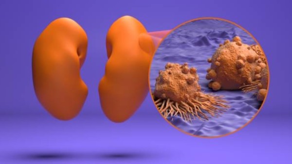 Terapi revolusioner ini dibuat dari sel punca yang kemudian diubah menjadi sel imun khusus bernama NKT (natural killer T cells). Uniknya, para peneliti melengkapinya dengan senjata tambahan berupa reseptor antigen kimera (CAR) yang mampu mengenali protein CD70, penanda khas pada sel kanker ginjal. Dengan cara ini, sel imun hasil rekayasa mampu melihat dan menyerang tumor dengan lebih efektif.