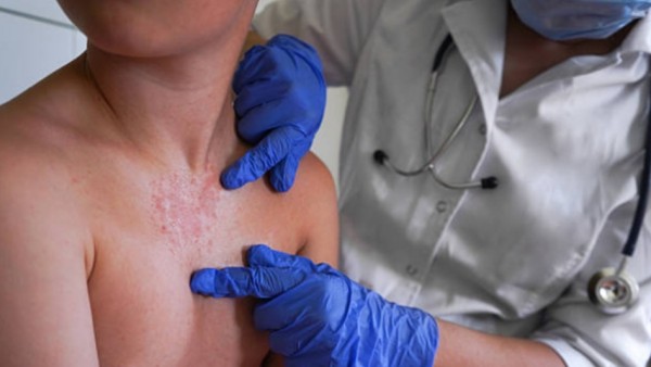 Anak ini terkena campak ketika masih bayi, sebelum usianya cukup untuk mendapat vaksin MMR (measles, mumps, rubella). Vaksin pertama seharusnya diberikan pada usia 12 hingga 15 bulan, lalu dilanjutkan dengan dosis kedua saat anak berusia 4 hingga 6 tahun.